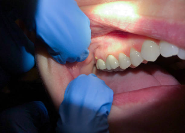 Best Emergency Broken Tooth Repair in Hendersonville, NC